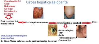 Ciroza hepatică se defineşte prin existenţa unor leziuni difuze ce asociază fibroza extensivă cu nodulii de regenerare, anomalii structurale ce dezorganizează arhitectonica normală a ficatului. Ciroza Hepatica Cu Evolutie Galopanta Cabinet De Gastroenterologie Si Hepatologie Bucuresti 0758 751 841 Cabinet De Gastroenterologie Si Hepatologie Bucuresti 0758 751 841