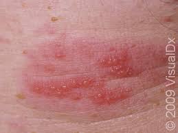 Image result for zoster under breasts