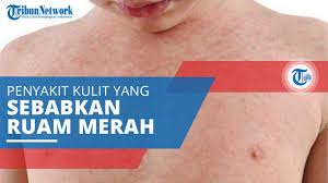 Anda mungkin terlalu fokus membersihkan bagian tubuh yang lebih mudah terlihat, sehingga melupakan area lain adanya eksim, ruam, serta dermatitis di belakang telinga bisa menyebabkan munculnya iritasi dan kulit kering. Penyebab Demam 5 Hari Dengan Ruam Kulit