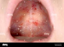 Image result for Physical injury red spots roof of mouth
