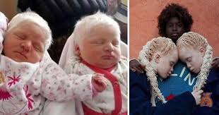 Although, there's no medical explanation for his condition. These Twin Were Both Born With Shocking White Hair