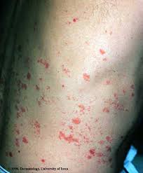 Deși aceasta poate apărea oriunde pe corp, de obicei apare pe partea stângă sau dreaptă a pieptului. Herpes Zoster Department Of Dermatology