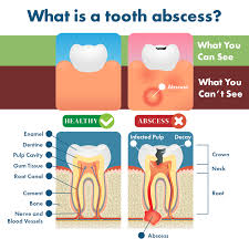What causes abscess on gum? Tooth Abscess Symptoms Remedies Complications Prevention