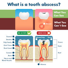 Wisdom teeth are notorious for the problems and pain they can cause, which is why 2 how to relieve pain from wisdom teeth coming in. Tooth Abscess Symptoms Remedies Complications Prevention