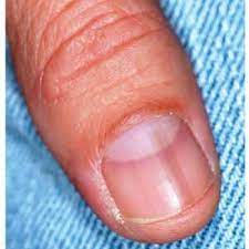 Signs and symptoms patients with melanoma. Diagnosing A Sun Exposed Thumbnail Clinician Reviews
