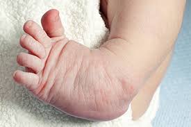 Image result for Clubfoot