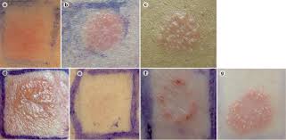 Image result for contact dermatitis