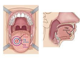 Stages Of Oral Tongue Cancer Headandneckcancerguide Org