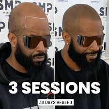 HEALED SMP ON BLACK SKIN