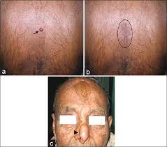 Muir Torre Syndrome Indian Journal Of Dermatology Venereology And Leprology