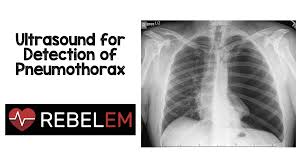 Symptoms of pneumothorax include shortness of breath, chest pain on one side and experiencing pain when breathing. Ultrasound For Detection Of Pneumothorax Rebel Em Emergency Medicine Blog