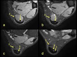 The abductor digiti minimi muscle is on the lateral side of the foot and contributes to the large lateral plantar eminence on the sole. Distribution Of The Subtendons In The Midportion Of The Achilles Tendon Revealed In Vivo On Mri Scientific Reports