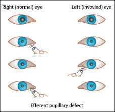 Image result for Pupillary Paralysis
