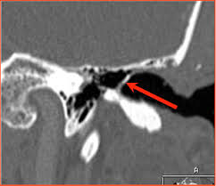 Image result for Myringosclerosis