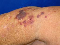 This appears as spots or patches of bruising that is red to purple in color. Senile Purpura Dermnet Nz