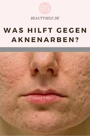 Akne Aknenarben Hautproblem Aknenarben Akne Hautpflege