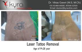 The packages for laser removal of accident/injury scars have a price range of rs 5,000 to rs 20,000. Before After Laser Tattoo Removal Cosmetic Surgery In Ludhiana Plastic Surgery In Punjab Laser And Cosmetic Surgeon In Ludhiana Punjab India