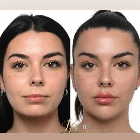 La armonización facial es un tratamiento increíble que nos permite resaltar  la belleza natural del rostro, logrando un equilibrio perfecto entre las  diferentes áreas del mismo. Utilizando ácido hialurónico, podemos dar  volumen,
