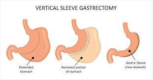 Yes, but only if your health insurance policy covers bariatric surgery. Gastric Bypass More Likely To Require Further Treatment Than Gastric Sleeve