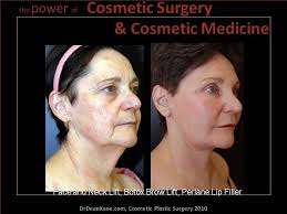 Pin On Facelifts