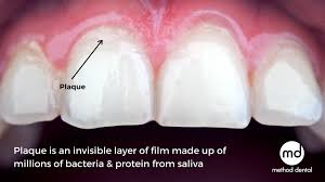 Image result for Plaque