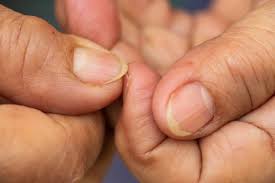 Eduardo isai perez munoz answered 8 Reasons Your Nails Are Yellow According To Dermatologists