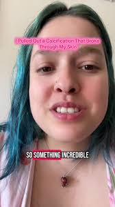 Calcium Deposit in Skin Removal