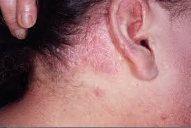 Estes são os sintomas mais comuns a nossa loção é um produto importante, que proporciona o alívio destes sintomas. Psoriase Do Couro Cabeludo Lesoes Cutaneas Erupcoes Pustulas Descamacao E Placas Galeria Da Saude