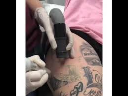 Jennifer lopez booty like that needs no undergarments. Lasertat Tattoo Removal Bye Iggy Azalea Youtube