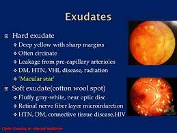 Cotton Wool Spots Vs Hard Exudates Google Search