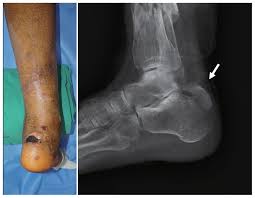 Image result for Calcaneus Compression Fracture