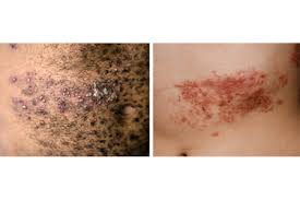 Image result for zoster under breasts