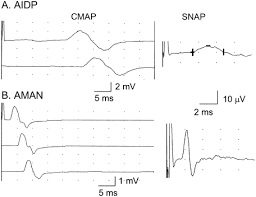 Traqueomalacia, artritis cricoaritenoidea trauma de tórax † fracturas costales † tórax inestable. Electrophysiological Subtypes And Prognosis Of Childhood Guillain Barre Syndrome In Japan Nagasawa 2006 Muscle Amp Nerve Wiley Online Library