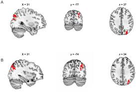 Deviation from the true middle of each line will be measured in mm. Testing For Spatial Neglect With Line Bisection And Target Cancellation Are Both Tasks Really Unrelated