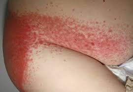 Image result for Candidiasis under breasts
