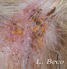 Image result for Trombicula autumnalis bites