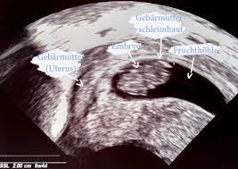 Dein Baby Im Ultraschall Mamiwiki