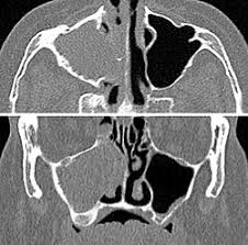 Image result for Sinus CT