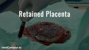 Image result for Retained Placenta