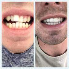 Straightening your teeth is possible without getting braces. How To Straighten Teeth Without Braces At Home Arxiusarquitectura