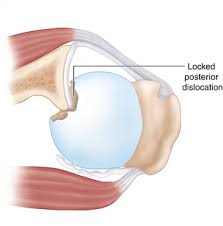 Image result for Chronic Shoulder Dislocation
