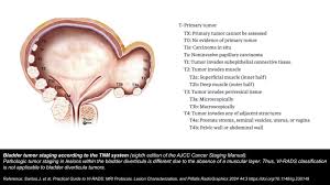 Image result for Bladder Cancer Staging