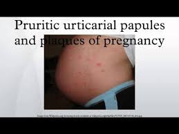 Image result for pruritic urticarial papules and plaques of pregnancy