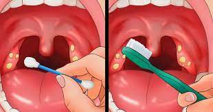 Jul 09, 2018 · if you can see the tonsil stone, you may be able to remove it by gently pressing on the tonsil with a cotton swab. 11 Tips For Removing Tonsil Stones That Ll Make You Sigh With Relief