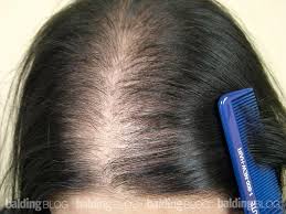 Here are some recommended treatments to try for baldness and thinning hair. How To Treat Female Hair Loss International Shia News Agency