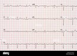 Image result for Extrasystole