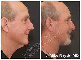 Lastly, your hair should remain above the neck region. Neckbynayak Neck Lift By Dr Mike Nayak St Louis Mo