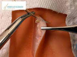 Deiscencia De Suturas Operatorias Identificar E Tratar Dr Marcus Hubaide Cirurgia Plastica