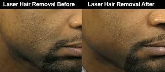 Hair free club may collect a share of sales or other compensation from the links on this page. Laser Hair Removal For Men In Atlanta Male Hair Removal