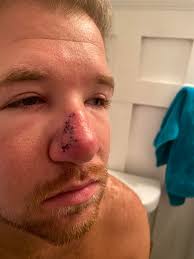 Skin cancers do not often cause bothersome symptoms until they have grown quite large. Personal My Journey With Basal Cell Carcinoma Skin Cancer On My Nose Skincareaddiction